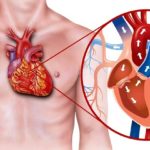Signs and Symptoms of Heart Disease in Men